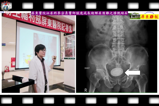 屏東醫院泌尿科李宗熹醫師談造成長期解尿困難之膀胱結石