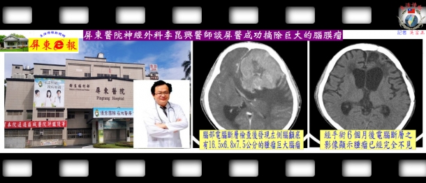 屏東醫院神經外科李昆興醫師談屏醫成功摘除巨大的腦膜瘤