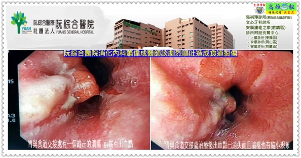 阮綜合醫院消化內科蕭偉成醫師談劇烈嘔吐造成食道裂傷